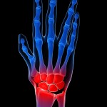 skeletal hand - arthritis