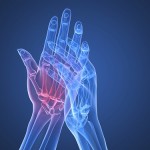 x-ray hands - arthritis
